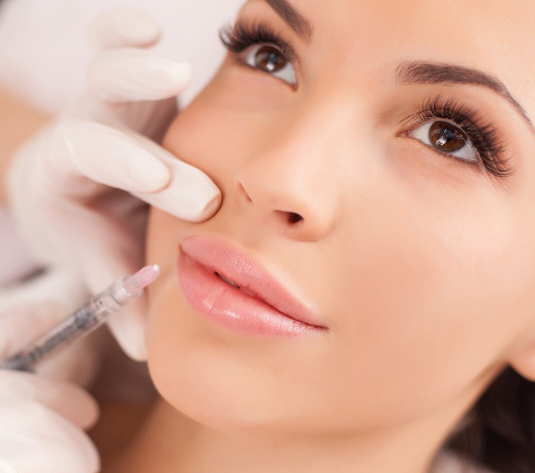 Lippen Modellierung mit Filler und Botox - Lipflip