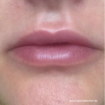 Lippen aufspritzen mit Hyaluronsäure in der LAJOLI Praxis für Fadenlifting und Faltenunterspritzung