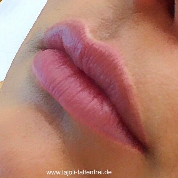 Lippen aufspritzen zum schönen verführerischen Kussmund in der ästhetischen Praxis LAJOLI für Faltenunterspritzung und Fadenlifting