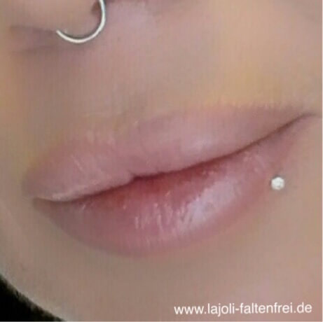 Lippen Modellierung mit Hyaluronsäure in der LAJOLI Praxis für Ästhetik in Hamburg - Lippen aufspritzen - Leja