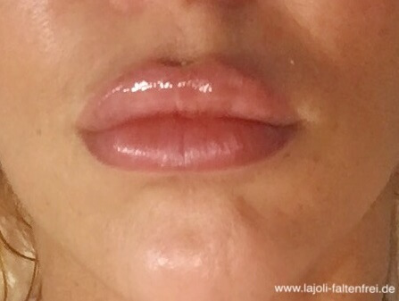 LAJOLI - Lippen aufspritzen mit Hyaluronsäure für mehr Volumen und einen verführerischen Kussmund - MakeUp