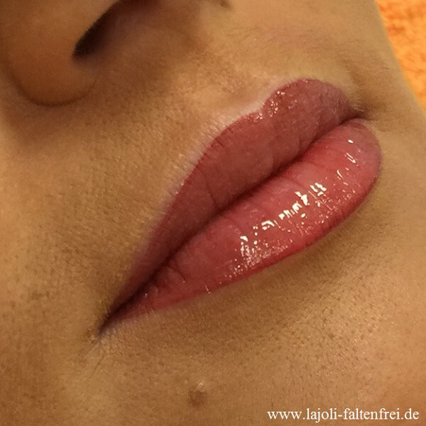 Lippen ganz natürlich aufspritzen mit Hyaluronsäure
