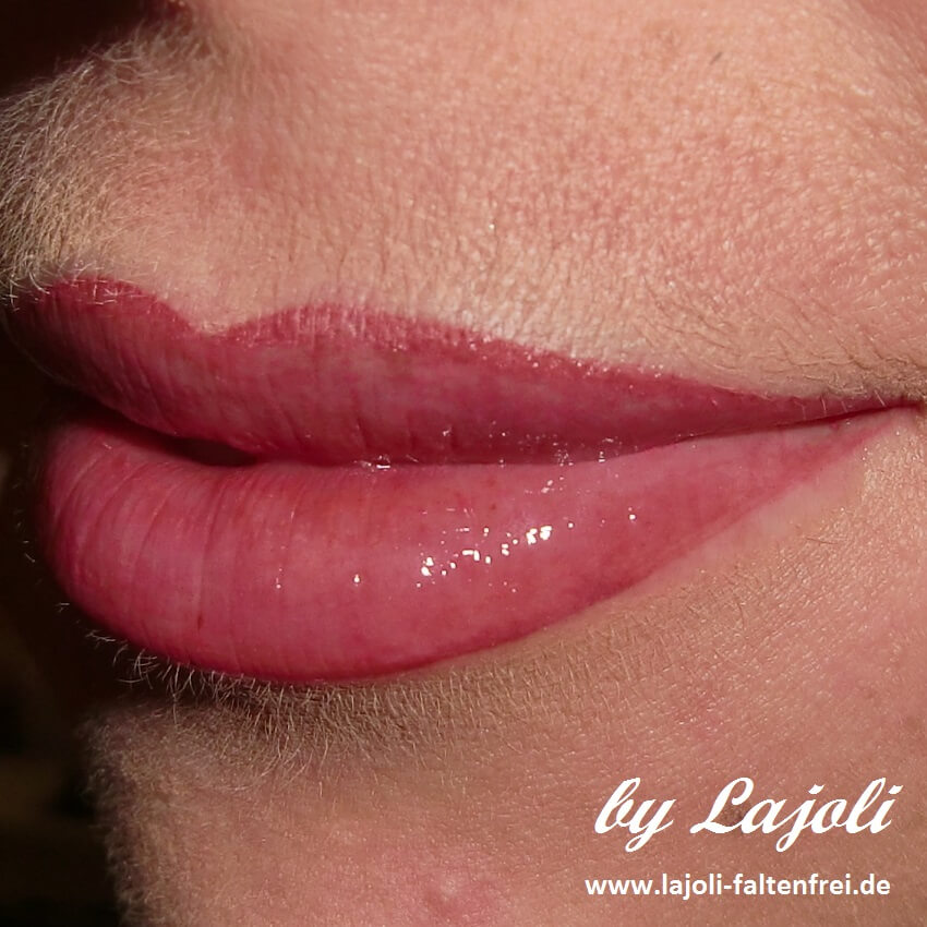 Lippen aufspritzen in der ästhetischen Praxis LAJOLI für Fadenlifting & Faltenunterspritzung