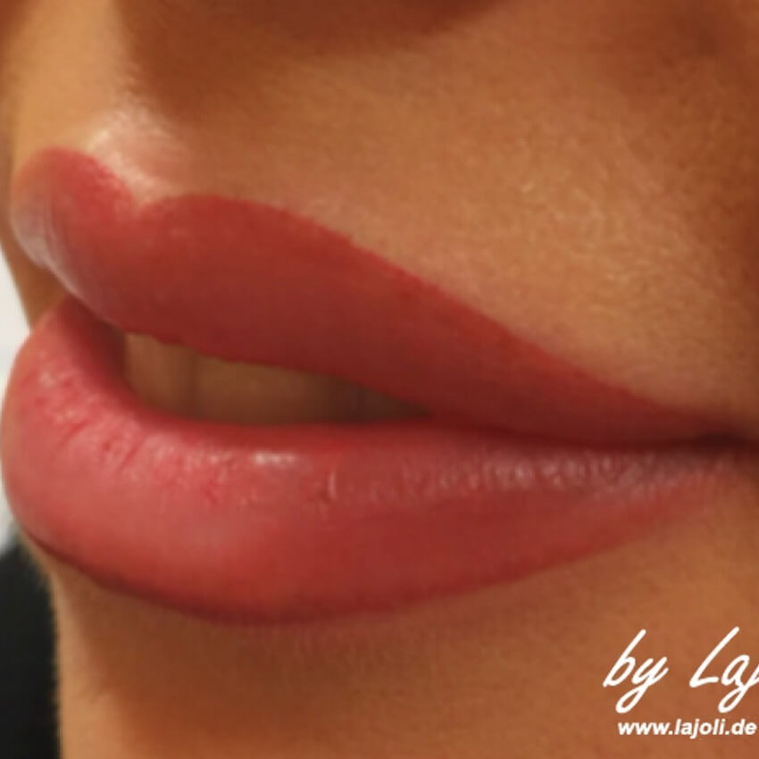 Bilder Lippen aufspritzen mit Hyaluronsäure bei LAJOLI 