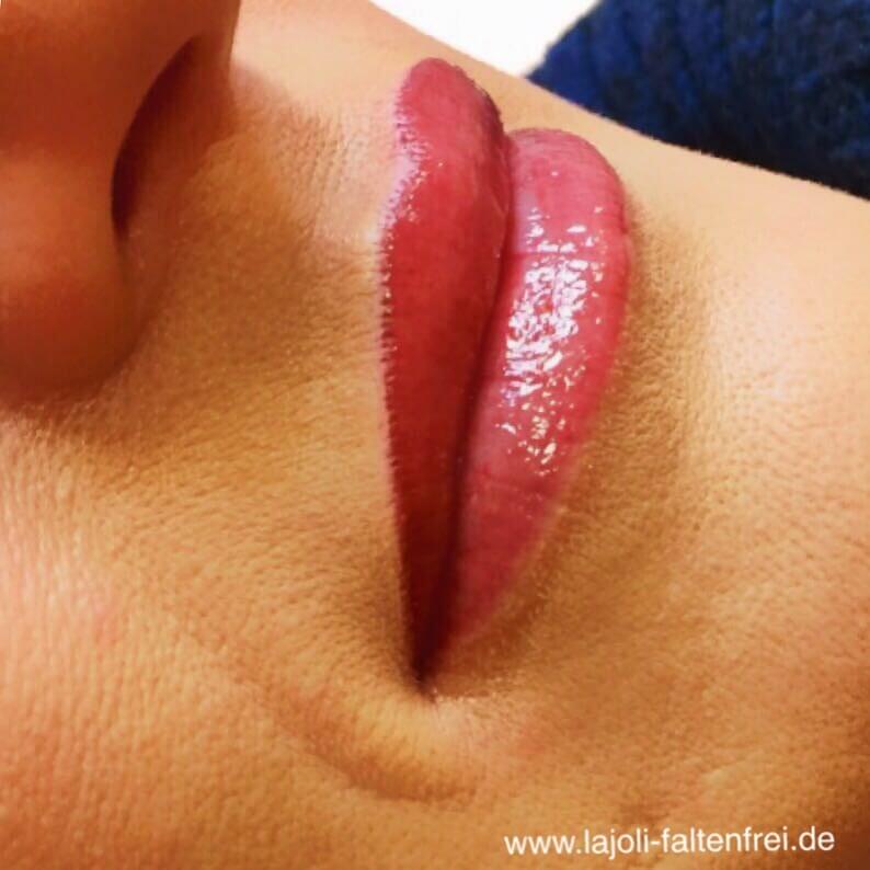 Lippen aufspritzen mit Hyaluronsäure in der ästhetischen Praxis LAJOLI für Fadenlifting & Faltenunterspritzung in Hamburg