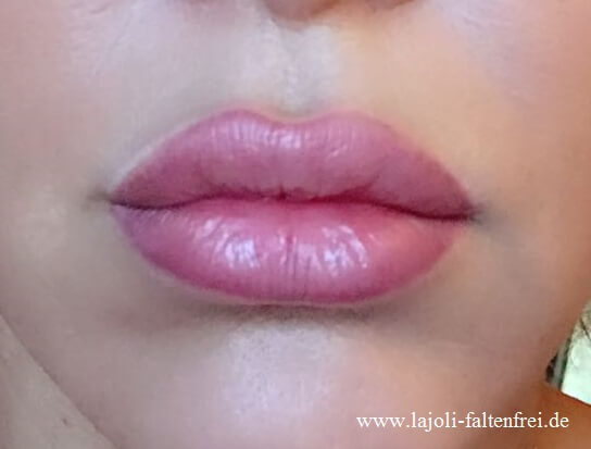 Lippen aufspritzen zum verführerischen Kussmund mit Hyaluronsäure