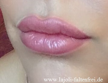 Lippen aufspritzen mit Hyaluronsäure für mehr Volumen und einen verführerischen Kussmund