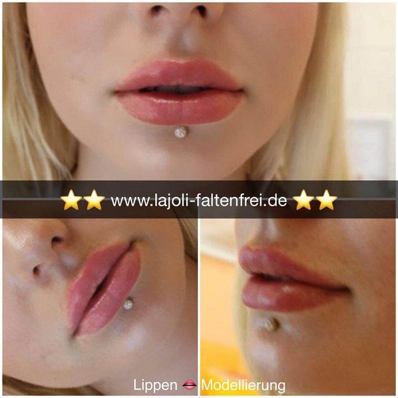 Lippen aufspritzen mit Hyaluronsäure - LAJOLI Praxis für Ästhetik Hamburg Leja - Botox, Fadenlifting, Permanent Make Up